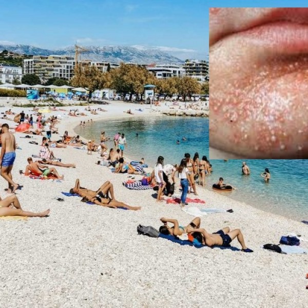 На хрватските плажи се појави инфекција со „слатка шуга“: Лекарите велат дека лесно се шири