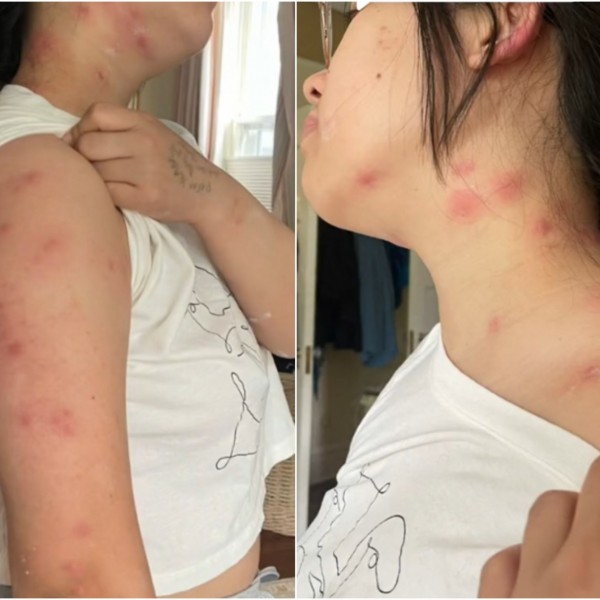 Mирно си спиела, па се разбудила со црвени пликови: Кога дознала што ја каснало, не можела да поверува... ВИДЕО
